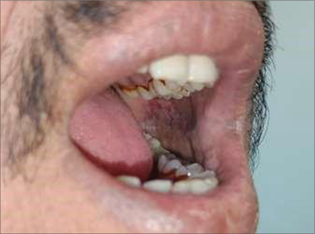 Difficulty in wide mouth opening and erythroplakia.