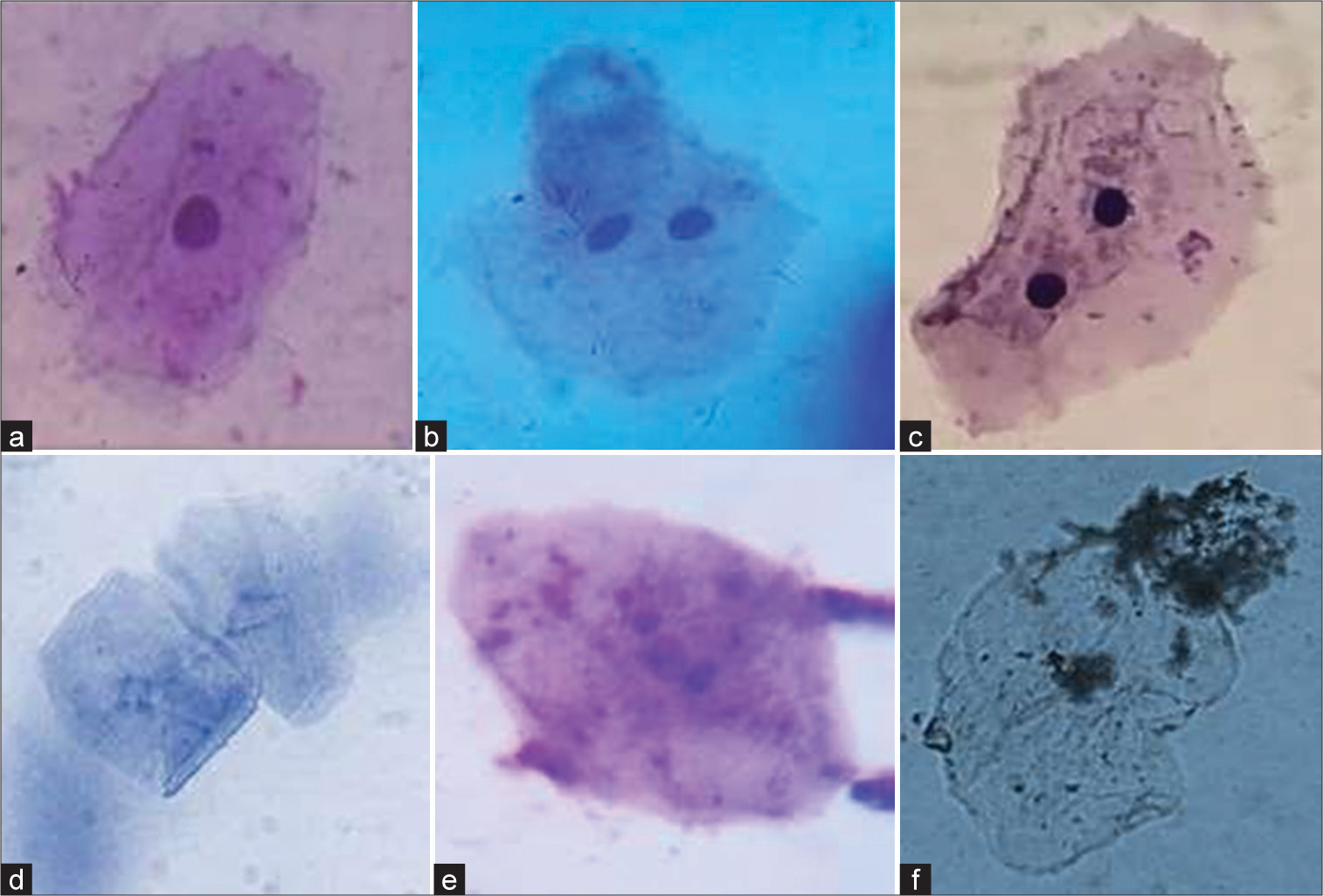 (a) A normal cell; (b and c) binuates; (d) ruptured nucleus; (e) fragmented nucleus and (f) pycnotic cell.