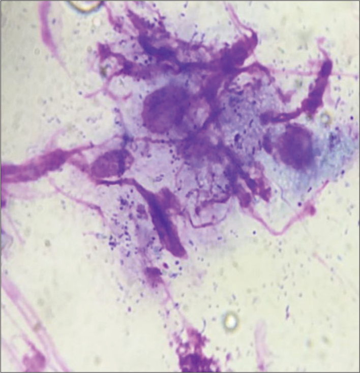 Cytology smear shows intracellular (macrophages) and extracellular Donovan bodies (Giemsa stain, ×100).