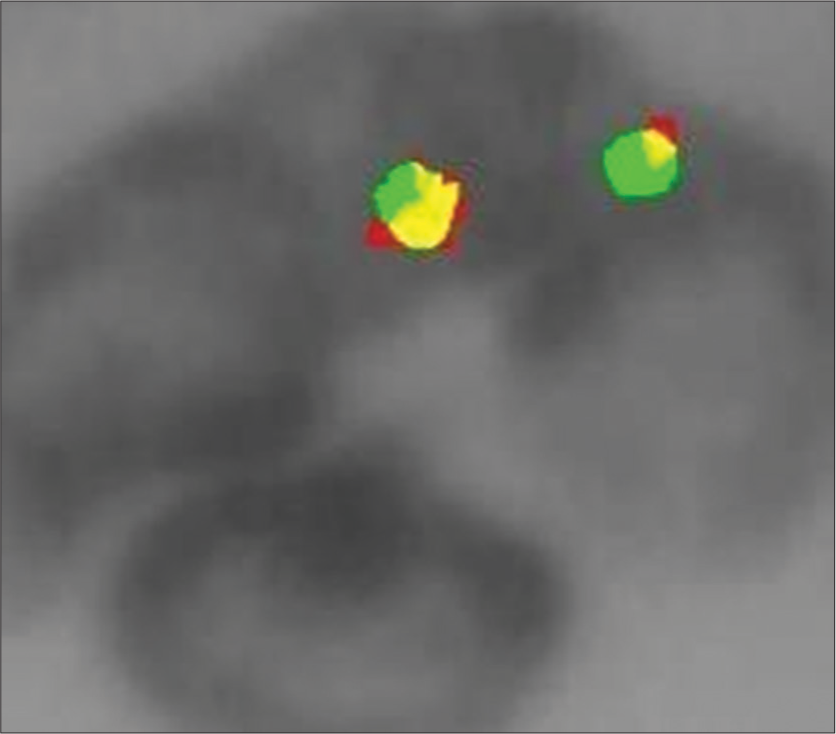 Interphase cells with 2 green/orange fusion signals of a male patient the ESWRI gene is absent, indicating no Ewing sarcoma.