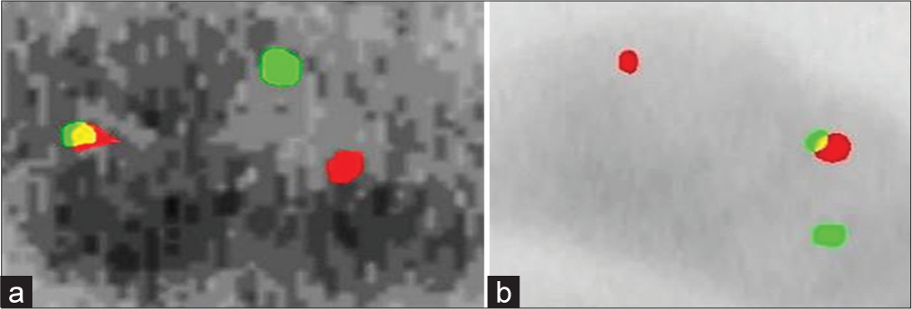 (a) Female interphase cells with 1 green and 1 orange and 1 green/orange signals (b) Male interphase cells indicating EWSRI gene with Ewing sarcoma.