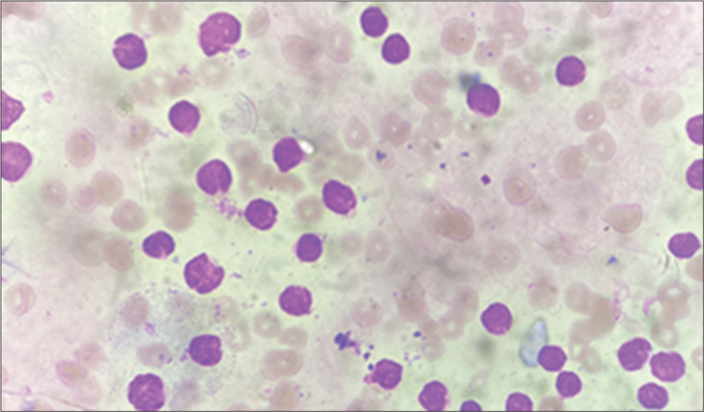 Acute lymphoblastic leukaemia (×100): The patient’s peripheral blood smear shows the presence of blast cells, which are small and uniform in size with scanty cytoplasm. Nuclei have coarsely clumped chromatin and indistinct nucleoli.