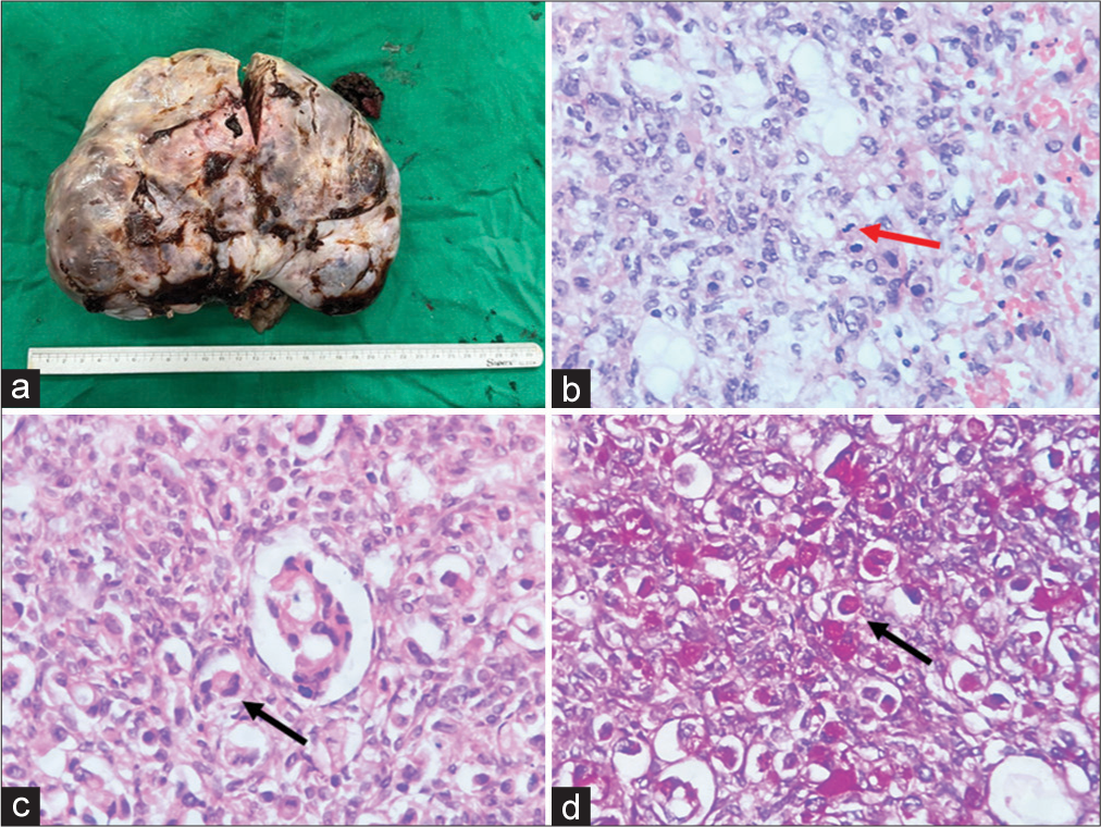 Right ovarian Kruckenberg tumour. (a) Gross image showing a large lobulated ovarian mass weighing 1,100 gm. (b) Histopathology (hematoxylin and eosin) showing occasional glandular lumina formation, increased mitotic activity (red arrow) and abundant intra-cytoplasmic mucin, (c) Histopathology (hematoxyllin and eosin) showing large signet ring cells (black arrow), (d) Diastase-resistant periodic acid Schiff (DPAS) stain showing large signet ring cells (black arrow).