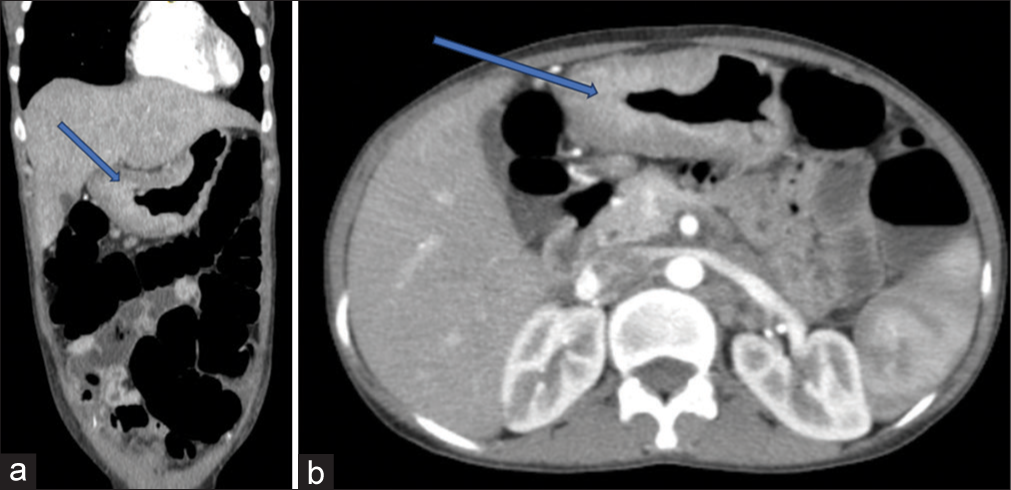 Contrast enhanced computerised tomography (CECT) images showing the stomach lesion involving distal body, pylorus, antrum and pyloro-duodenal junction (blue arrows) a) coronal view. b) CECT axial view..