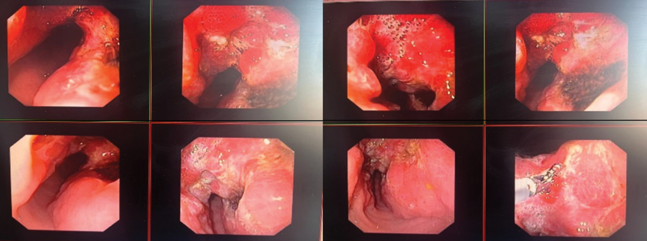 Upper gastrointestinal endoscopic images showing the gastric lesion at distal body and antrum, along with the lesser curvature of the stomach.