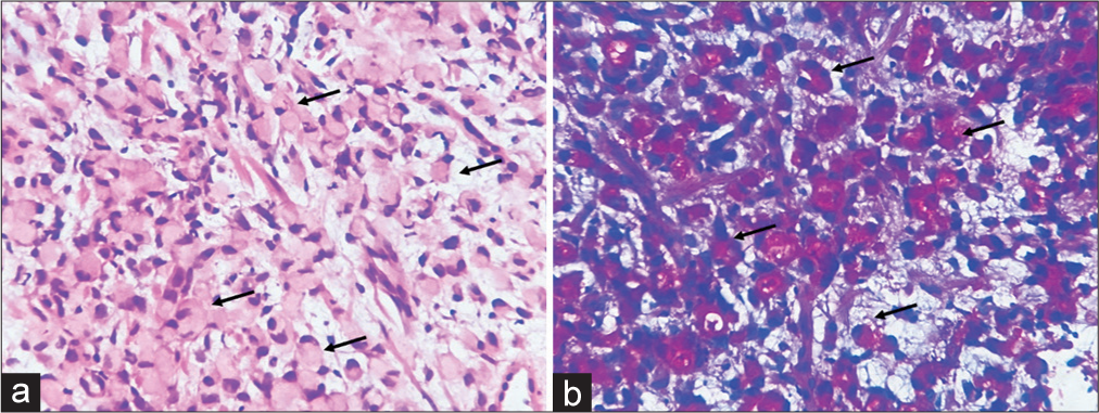 Gastric biopsy showing signet ring cell carcinoma. (a) High-power view showing numerous signet ring cells (black arrows), ×400; hematoxylin and eosin and (b) signet ring cells filled with intra-cytoplasmic mucin (black arrows), ×400; combined Alcian blue-Periodic acid Schiff stain.