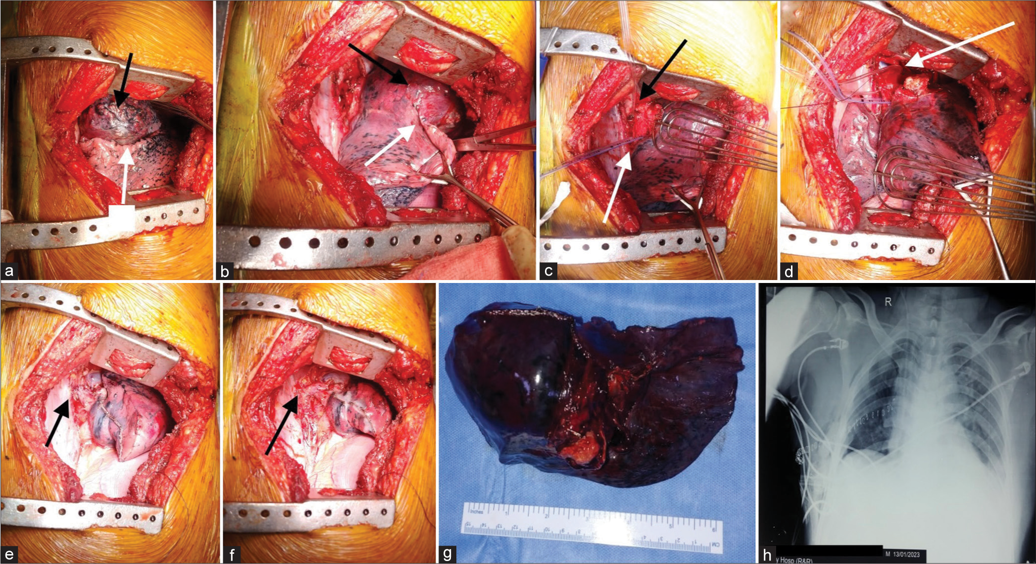 Intraoperative images. (a and b) Mass in the right upper lobe (black arrows) with well-defined oblique fissure (white arrows). (c) Right main (black arrow) and lower lobe bronchus (white arrow) looped. (d) Right main bronchus was cut open above the lesion with gross negative margin and intact membranous portion (arrow). (e and f), Completed lower lobe bronchus to main bronchus stump anastomosis (arrow) covered with mediastinal pleural patch (arrows). (g) Resected specimen with right upper and middle lobe and growth at the bronchus. (h) Post-operative chest X-ray showed adequately expanded right lower lobe.