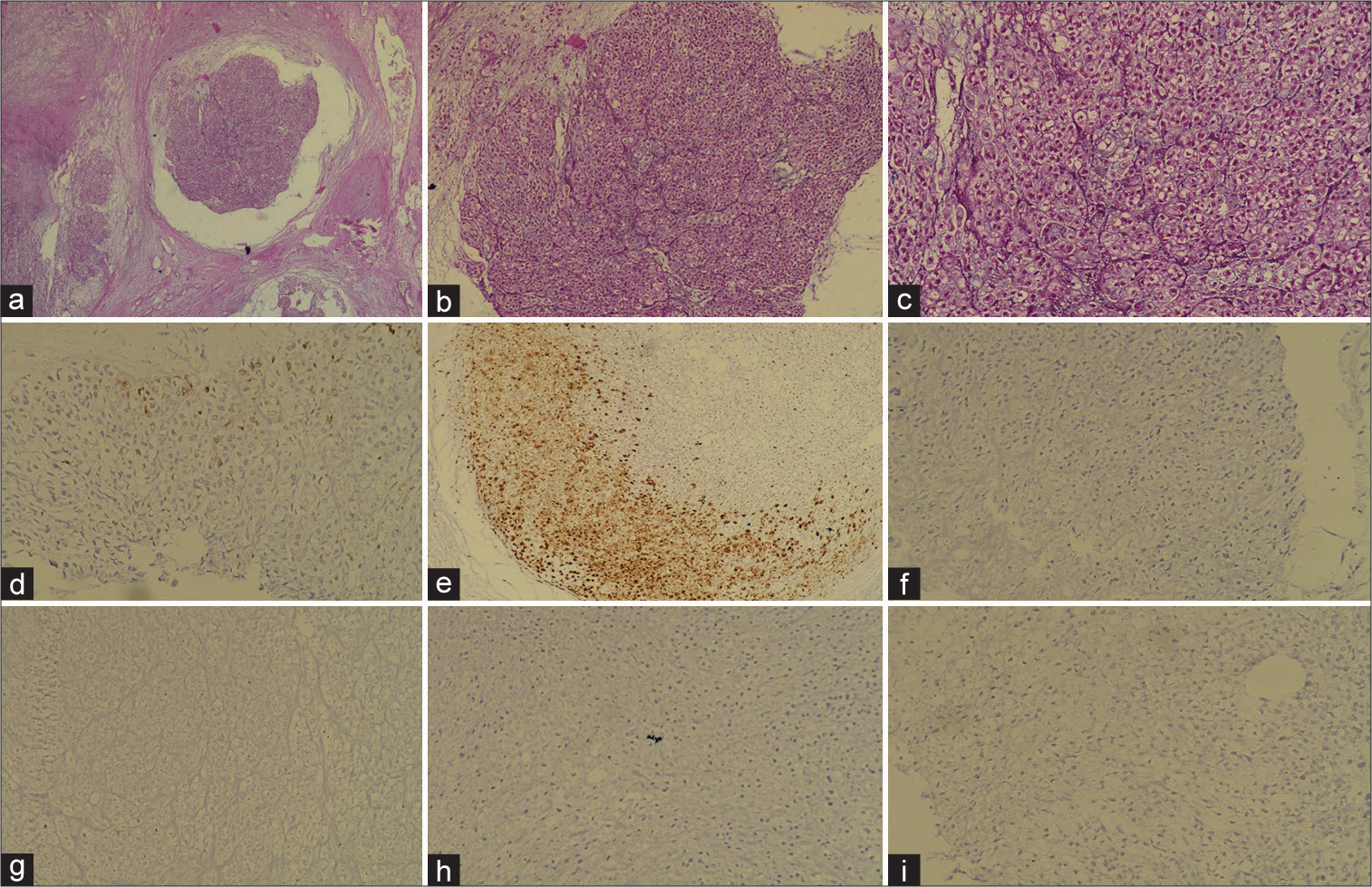 Histopathology images. (a) Haematoxylin and eosin (H&E) stain with ×10 magnification showing tumour in nested pattern with chondromyxoid stoma. (b), (c) H&E stain with ×20 magnification showing multinucleation and brisk mitosis. (d) EMA focal positive. (e) S-100 positive. (f) Pan-CK negative. (g) CD99 negative. (h) CD56 negative. (i) Synaptophysin negative.